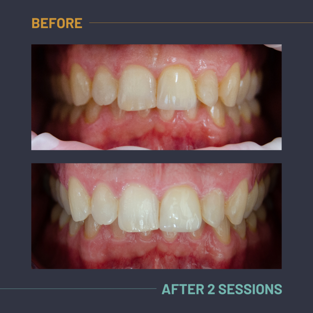 Nuvola_Tonic_Before:After1