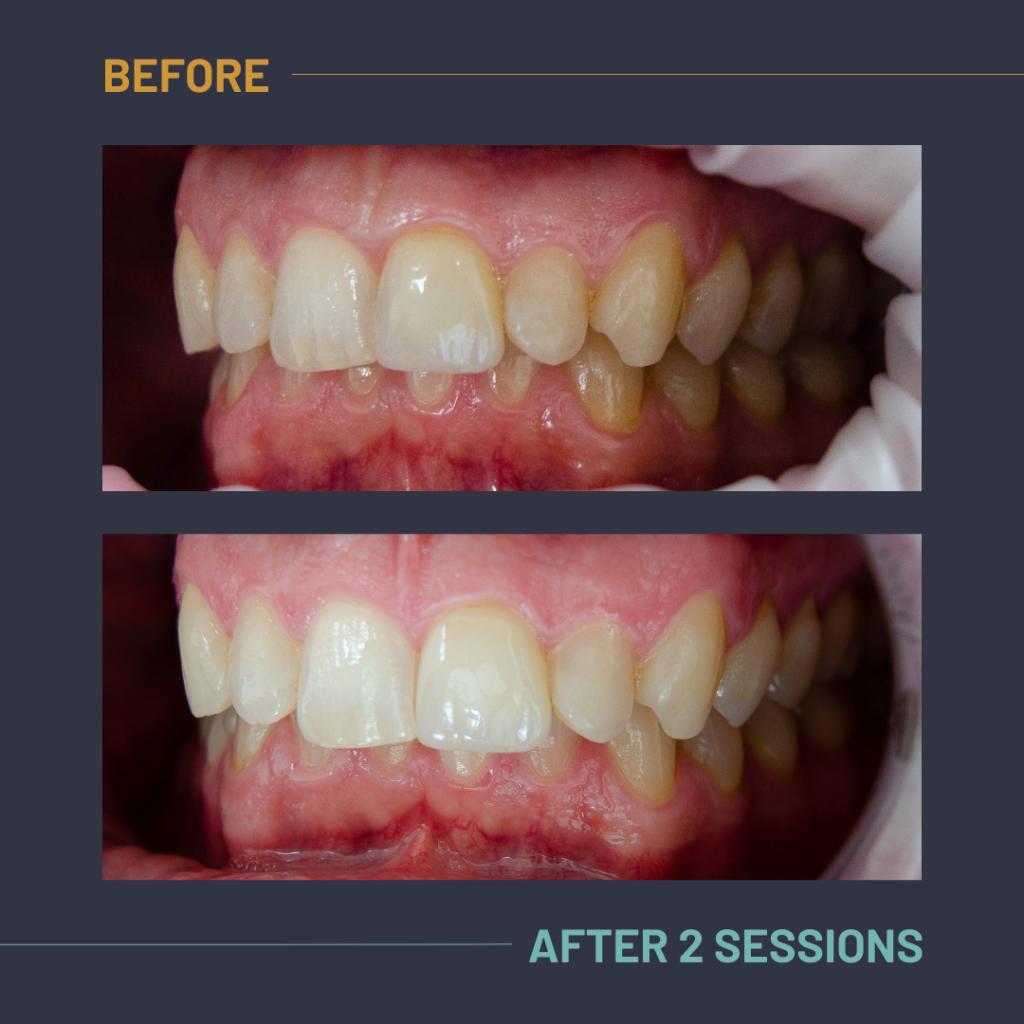 Nuvola_Tonic_Before:After2
