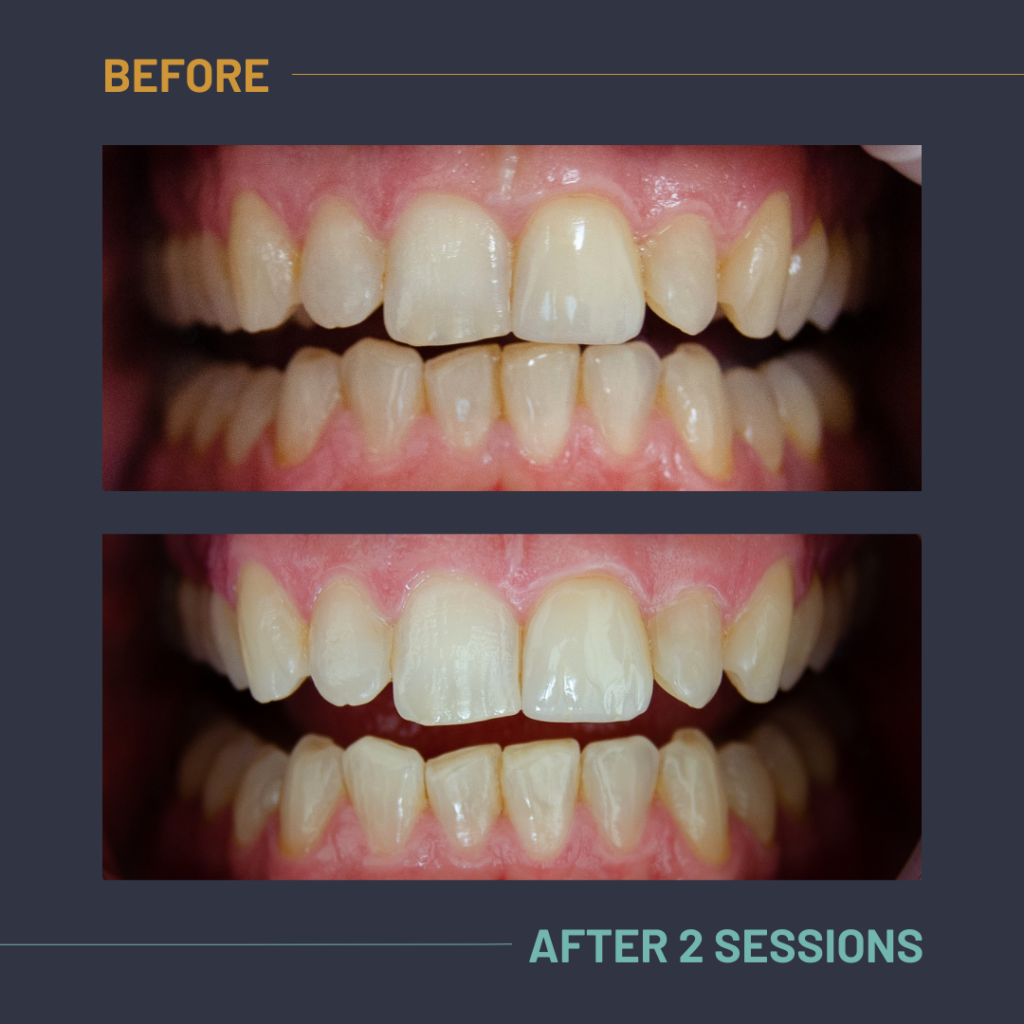 Nuvola_Tonic_Before:After3