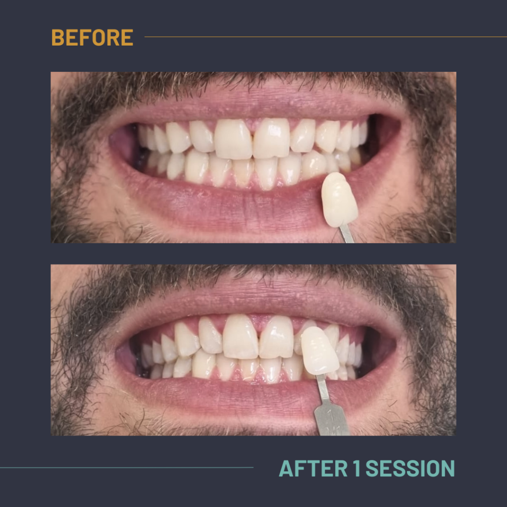 Nuvola_Tonic_Before:After7